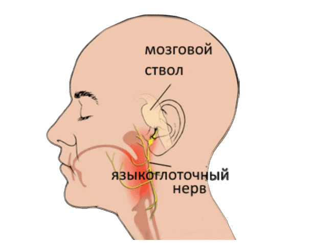 Стреляющая боль за ухом: к лору или неврологу?